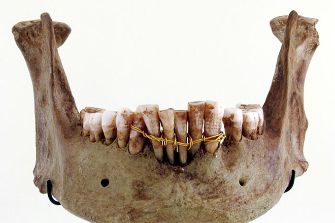 Подобие зубных имплантов в Древнем Египте